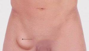 The majority of these signs are harmless and should disappear without treatment with time. Painful Lump in groin area of male & female: Symptoms ...
