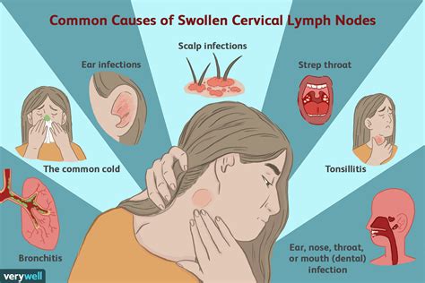 Swollen lymph nodes are enlarged lymph nodes, which are very small clusters of immune cells that function as part of the body's immune system. Enlarged Cervical Lymph Nodes