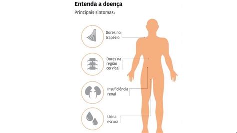 A doença de haff surge de forma repentina e os sintomas podem se manifestar entre 2 e 24 horas na grande maioria dos casos os alimentos relacionados com a doença de haff são peixes de água. Bahia registra novos casos da doença de Haff e 80% das ...