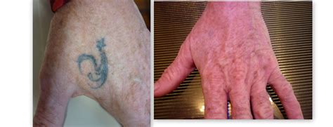 Blend them and make a thick and soft paste. Laser Tattoo Removal Before & After 6 treatments on the ...