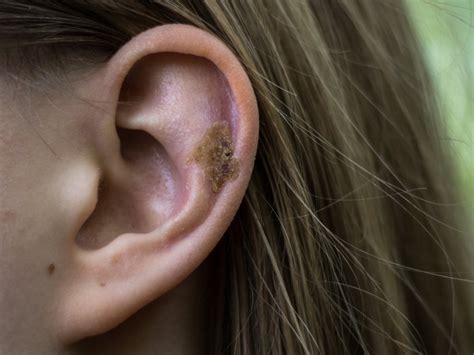 Music to my ears — john jacobson. What Causes Scabs In My Ear? | Balmonds