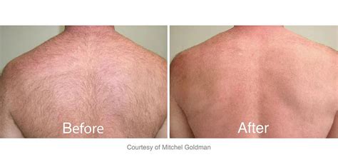 Chemical cold packs are not recommended, if their temperature is below 4°c. Laser Hair Removal: Permanent Hair Reduction in Long Island