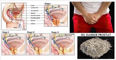 Uluslararası kılavuzlar ve klinik deneyimler işığında. INFO TERBAIK!! KANSER PROSTAT PERINGKAT 4 BOLEH ...