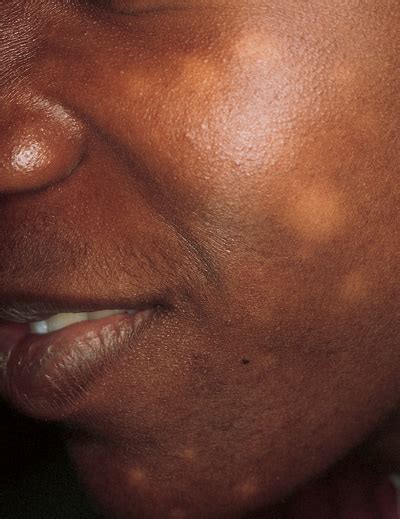 Pityriasis versicolor, sometimes called tinea versicolor, is a common condition that causes small symptoms of pityriasis versicolor. White areas on the face of a teenager - The Clinical Advisor