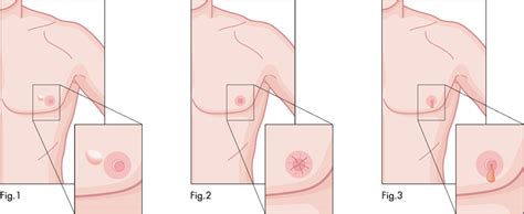 Rapid change in the appearance of. Male Breast Cancer Signs, Symptoms, Treatment