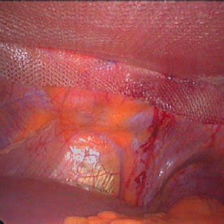 Hi, i saw a surgeon a few weeks ago who confirmed that i have an incisional hernia, it's on the left side of the scar from when my large bowel was removed. CT-Scan of a patient with a large incisional hernia. The ...