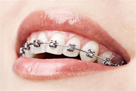 Tmj conditions can be covered by either dental or medical insurance, but tmj conditions are not among those conditions that insurance providers were ordered to cover under the affordable care act. Orthodontic Treatment | Dental Occlusion | Direclin Dental ...