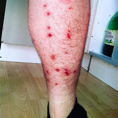 Beg bug bites, much like flea bites, also cause red itchy bumps. Do Bed Bug Bites Hurt? - Everything You Need To Know ...