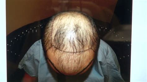 So, it is impossible to define a specific price for how much treatment costs without seeing and. Advanced Hair Loss Before After Transplant Surgery Dr ...