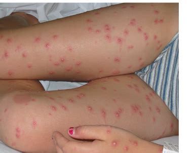 The monkey pox is most commonly found in the central african and west african regions. Published: April 18, 2004