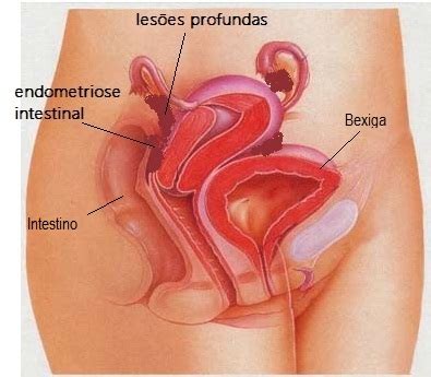 Alguns sintomas da doença são. Sintomas da Endometriose Intestinal | Tretando Portal