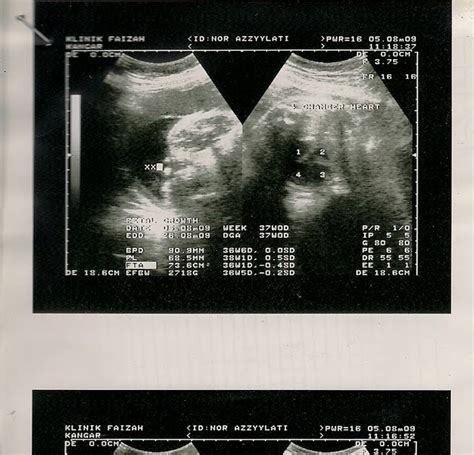 Hari ke 5 baru boleh scan dgn pakar jantung dr balqis sbb dia the only pakar jantung. KAMI SALING MELENGKAPKAN: Gambar Scan baby....