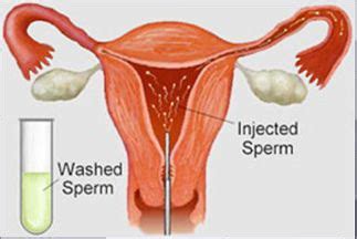 It usually requires the insertion of a speculum and then the. IUI - Artificial Intrauterine Insemination - Women Health ...