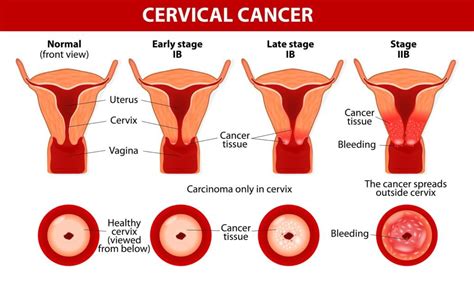 Cervical cancer is cancer that begins in the uterine cervix, the lower end of the uterus that contacts the upper vagina. Cervical Cancer | Dr Amy Tang | Gynaecological Oncologist ...