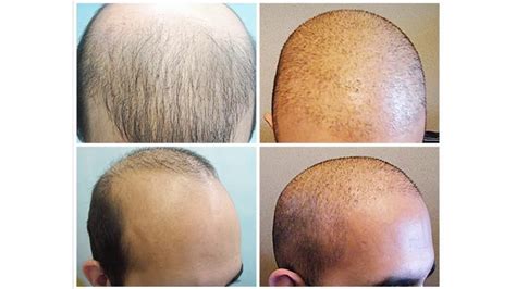 3520 e tropicana ave, las vegas, nv 89121, usa. Revive Hair Restoration In Las Vegas - YouTube