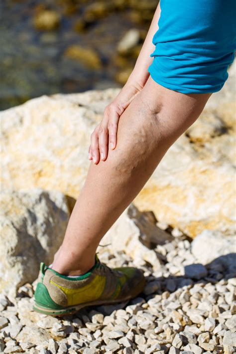 Varicose Veins - McQuaid Vein Care