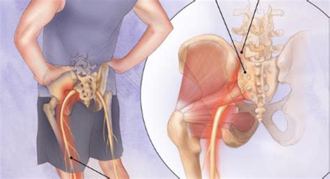 Relief from sciatica pain without surgery and painkillers. Sciatica: Treatment Cost, Causes & Symptoms - Medmonks