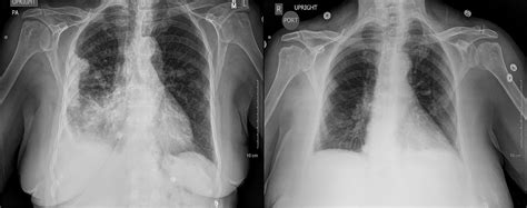 These fibers get lodged into the protective lining of the lungs (the pleura), causing genetic mutations in the surrounding cells. Cureus | Malignant Pleural Mesothelioma, Biphasic Type: An ...