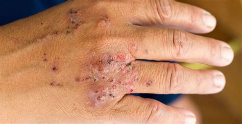 Contact dermatitis is a type of inflammation of the skin. Allergic Contact Dermatitis I Advanced Dermatology of the ...