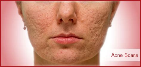 Jom lihat senarai panjang krim dan gel terbaik untuk memudarkan dan menghilangkan semua jenis parut, dari luka pembedahan, stretch mark seterusnya parut jerawat! PARUT JERAWAT HILANG SELEPAS MENGGUNAKAN SET JERAWAT ...