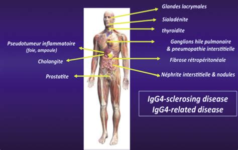 Pancréatite auto-immune (PAI) – FMC-HGE