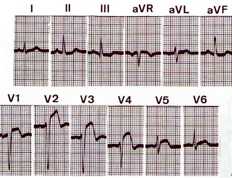 Ecg, enzimas cardíacas e exames cardíacos de imagem não são específicos para miocardite, mas ecg pode ser normal ou anormal em pacientes com miocardite. Mi si spezza il cuore