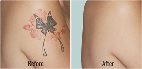Before and after laser tattoo removal treatment while your tattoo may seem — and it was intended to be — permanent, the wide variety of photos shown in our before and after laser tattoo removal gallery show that the experts at medermis laser clinic are able to completely remove the pigment, giving you fresh and clean skin. Laser Tattoo Removal Before and After