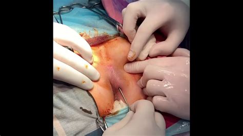 Pilonidal disease is a type of skin infection which typically occurs as a cyst between the cheeks of the buttocks and often at the upper end. Эпителиальный копчиковый ход.Pilonidal cyst. - YouTube