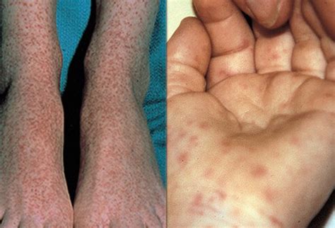 Despite the availability of effective treatment. The Dangers of Rocky Mountain Spotted Fever (RMSF)