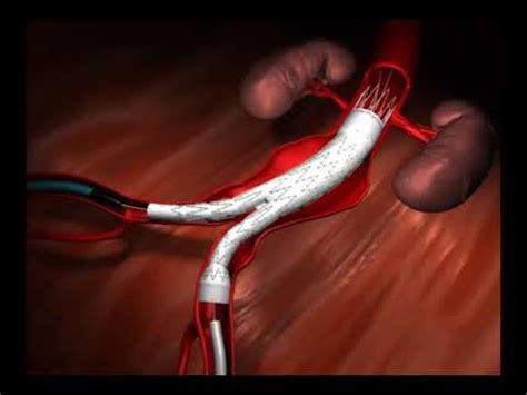 Algunos aneurismas aórticos abdominales se agrandan a una velocidad de 10%/año. Cirurgia de Aneurisma da Aorta Abdominal Endovascular ...