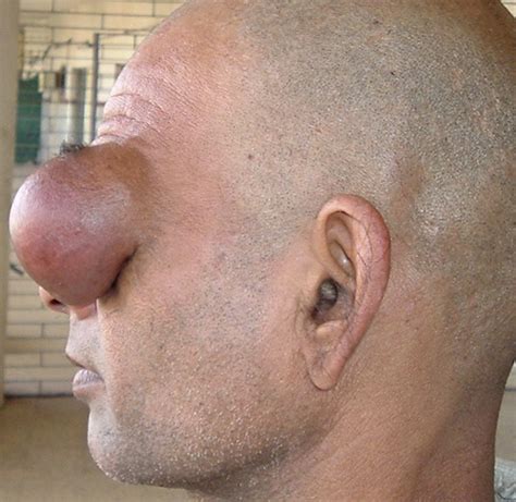 We did not find results for: dermoid cyst | Medical Pictures Info - Health Definitions ...