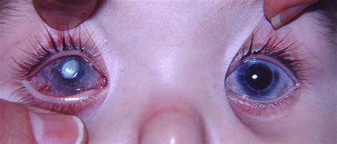 Bacterial keratitis diagnosis and treatment. Paediatric infectious keratitis at tertiary referral ...