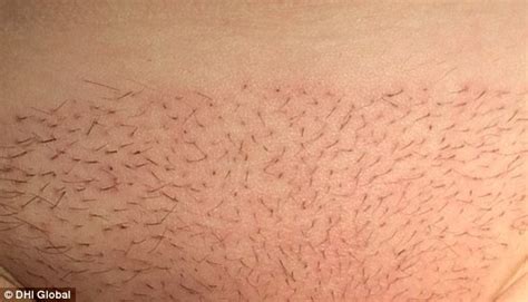 For hairy and shaved female genitalia. Fashion for natural pubic hair sees surge in women undergoing follicle transplants on their ...