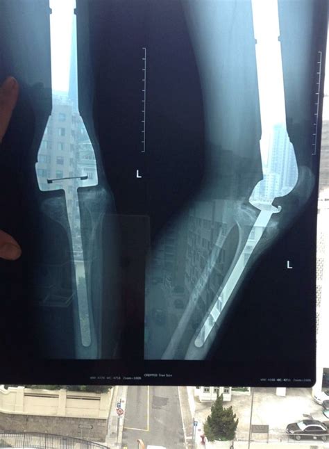 Dos and don'ts of a blood clot. An entire-femoral and partial-tibial replacement I had ...