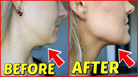 How does the movie end? KYBELLA BEFORE AND AFTER 1 MONTH PICTURES - YouTube