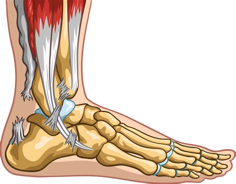 When this tendon is put under excess strain, it can become inflamed. When Your Achilles Tendon Tears or Ruptures - Triad Foot ...