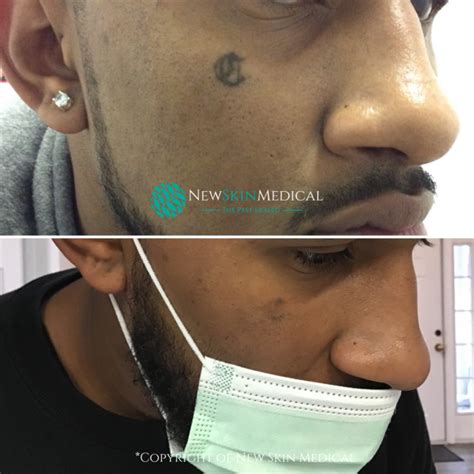 The tattoo artist messed up the design, and as a result, it is crooked. #1 Laser Tattoo Removal | New Skin Medical | Augusta, Ga