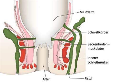 Eine beule in der leiste, zwischen bauch und oberschenkel: Welche Symptome verursacht eine Fistel? - netdoktor.at