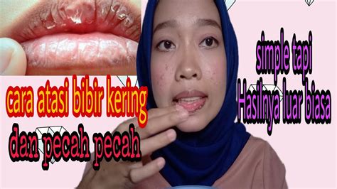 Bibir kering atau patah sangat biasa. Cara mengatasi bibir kering dan pecah pecah dengan mudah ...