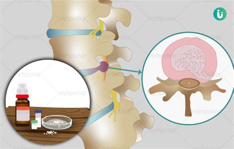 The welling homeopathy treatment can help you get faster relief from symptoms which include. Homeopathic Treatment, Medicines, Remedies for Slipped ...