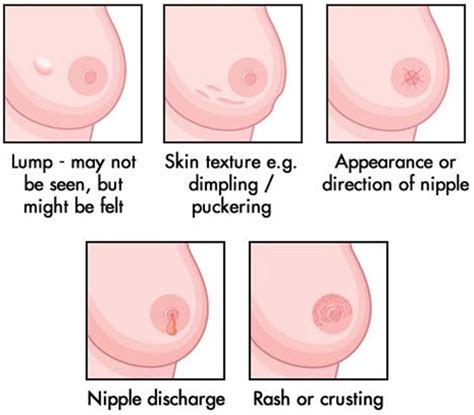 Please take a good look at this photo. How do you know you have breast cancer? - Rediff.com Get Ahead