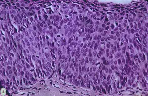 La neoplasia intraepiteliale cervicale cin di grado 2 e 3 è stata impiegata negli studi clinici come surrogato del cancro della cervice uterina. Herpes genital indicaría cáncer uterino