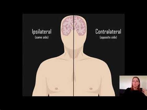 Spinal cord lesion explaining how the terms ipsilateral and contralateral deficits are determined. Ipsilateral vs Contralateral - YouTube