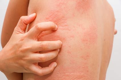 Unlike other skin allergies, hives aren't dry or scaly and can appear anywhere. Food Allergy Rash Symptoms and Treatment - Healthy Skin Care