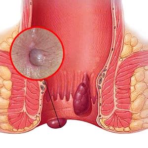 Internal hemorrhoids are located up inside the rectum. Hemorrhoids