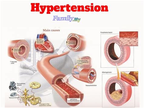 Available in pmc 2019 apr 23. Booklet: Hypertension Medicine Malaysia