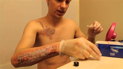 Tca is an acid that works by removing the top layers of skin. TCA 40% Tattoo Removal Second Applications - YouTube