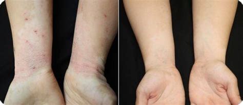 Treatment for eczema on hands. Eczema Free You Review: A USER'S EXPERIENCE AND RESULTS!