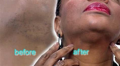 You could stop all forms of hair removal and hope for the best. Woman scarred after having laser treatment to remove hairs ...