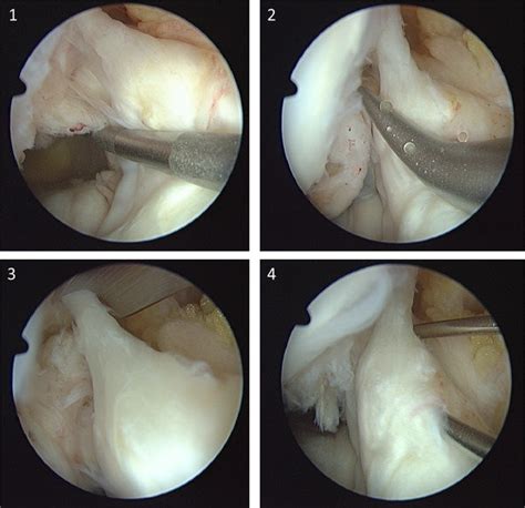 It has been slightly stretched but not torn. Treatment with trephination of the ACL origin and ACP application: (1)... | Download Scientific ...